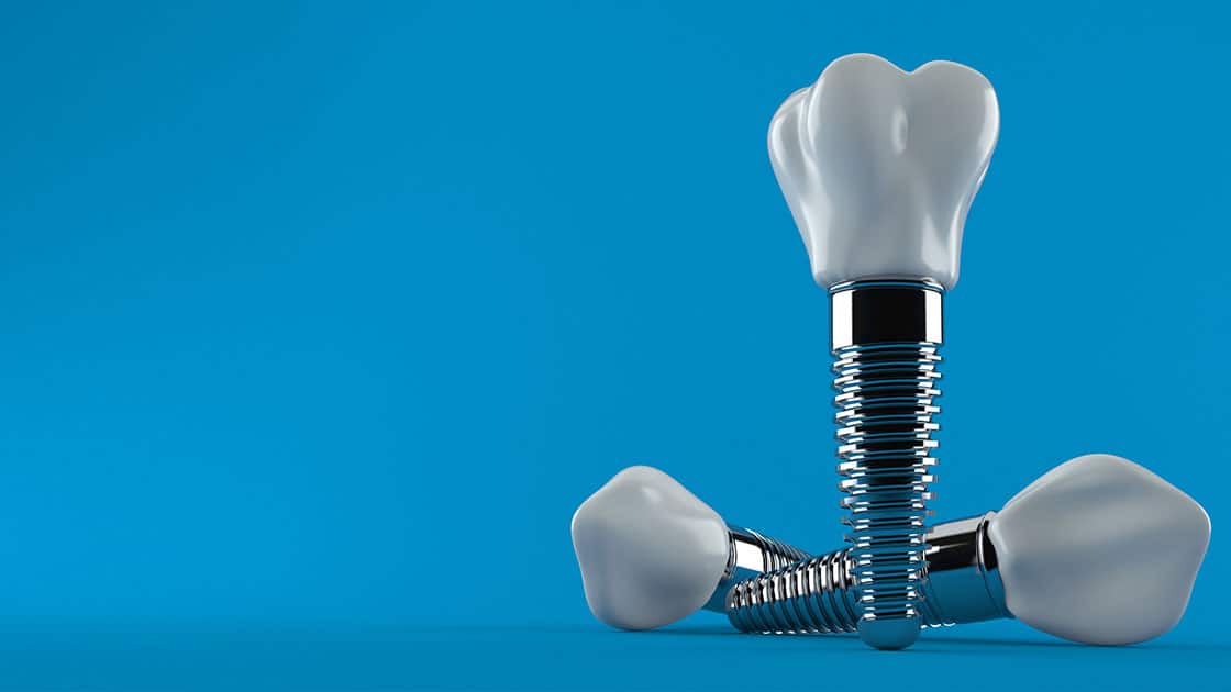 Dental Implants Image