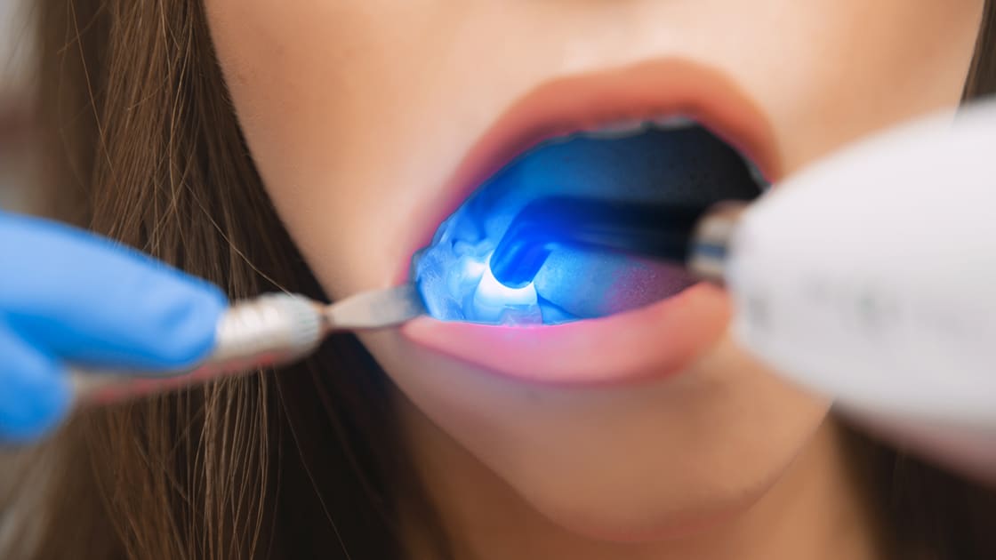 Laser Dentistry